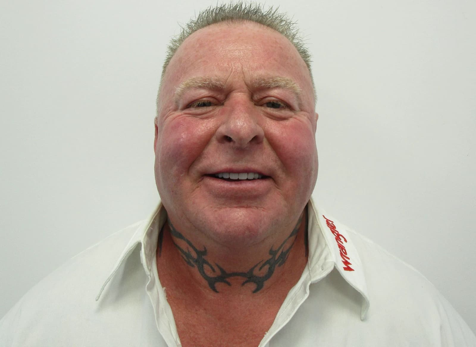 Face portrait of the same patient after full-arch implant treatment