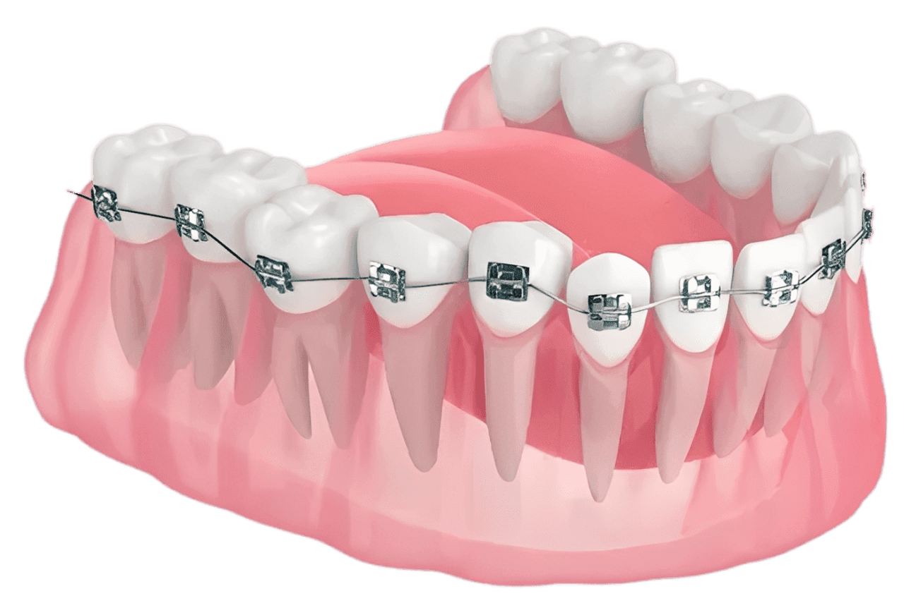 Illustration of metal dental braces on a lower dental arch