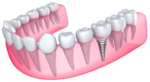 Single dental implant replacing a missing tooth